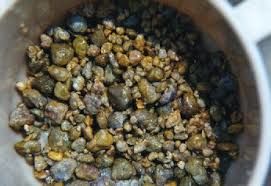 چگونه سنگ کیسه صفرا را درمان کنیم؟