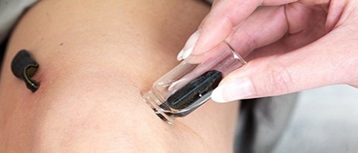 حجامت و زالودرمانی بیمه نیستند