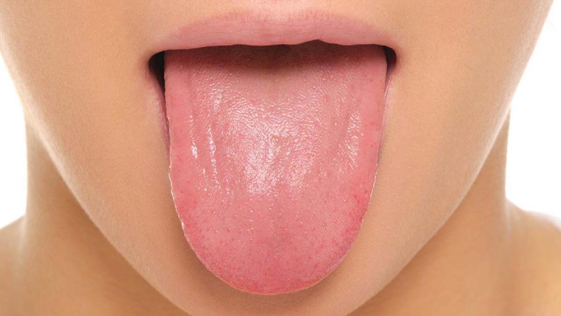 تغییر رنگ زبان نشانه کدام بیماریهاست؟ تغییر رنگ زبان نشانه کدام بیماریهاست؟