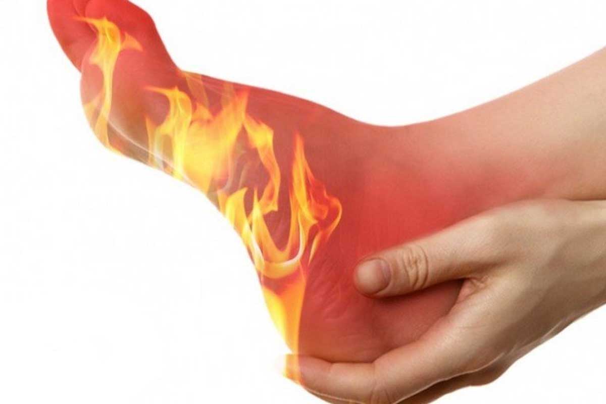 سوزش کف پا نشاندهنده کدام بیماری است؟ سوزش کف پا نشاندهنده کدام بیماری است؟