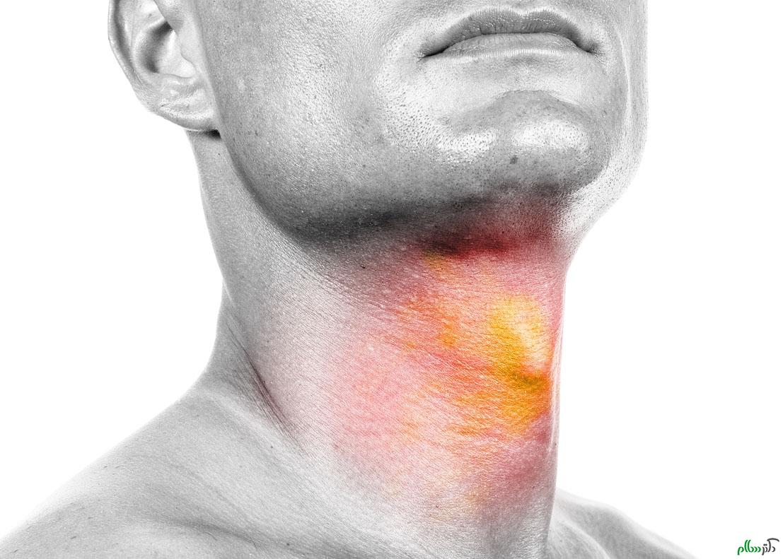 علائم هشدار ابتلا به سرطانهای سر و گردن علائم هشدار ابتلا به سرطانهای سر و گردن